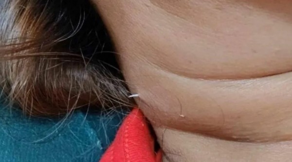 Korku filmlerini aratmayan olay! Yuttuğu balık kılçığı boynunu delip dışarı çıktı